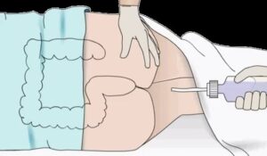 Enema BDSM Cams The History of Enemophilia